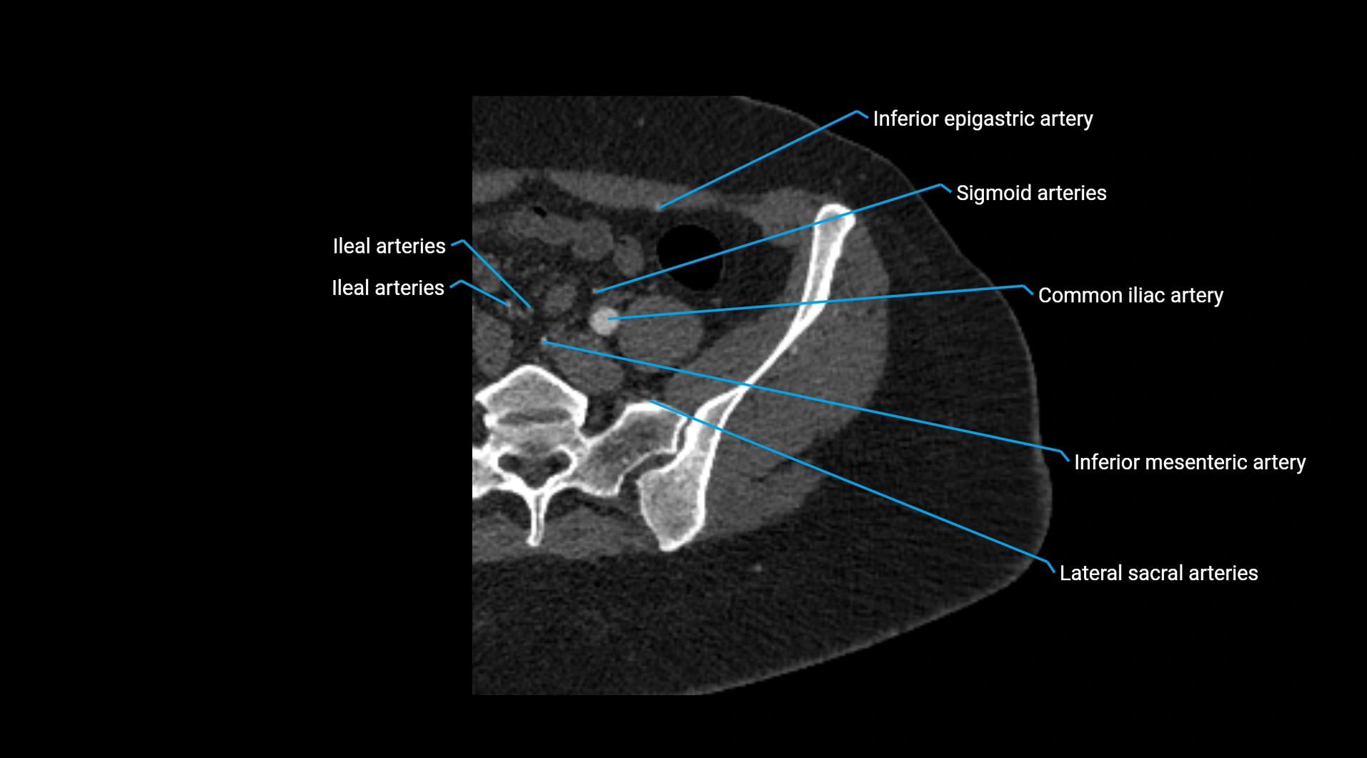 CTA lower limb cross sectional anatomy labelled image _19.webp